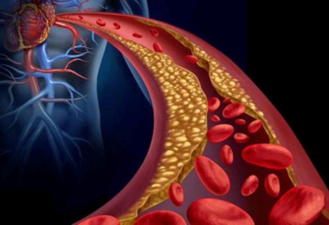 血栓|血栓“溶解剂”或许找到了,平时换着吃,帮助清血脂,预防血栓