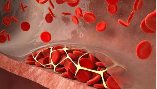 肾病|多吃发酵食品，能减少体内炎症？医生：这4类食物可以多吃