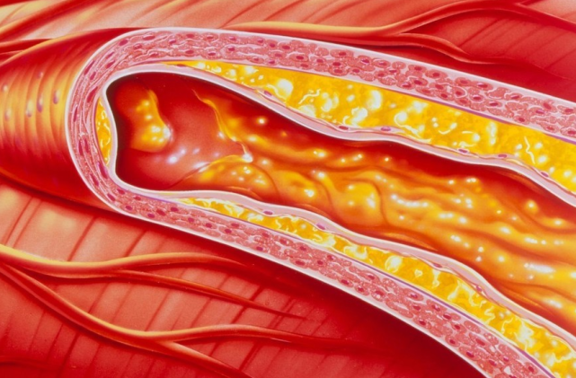 老程健康谈|37岁月嫂脑梗入院，抢救后瘫痪，医生：常吃1种粗粮等于在喝油