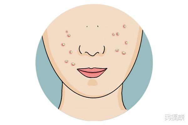 痘痘|一来月经就容易长痘，跟什么有关？是在排毒？