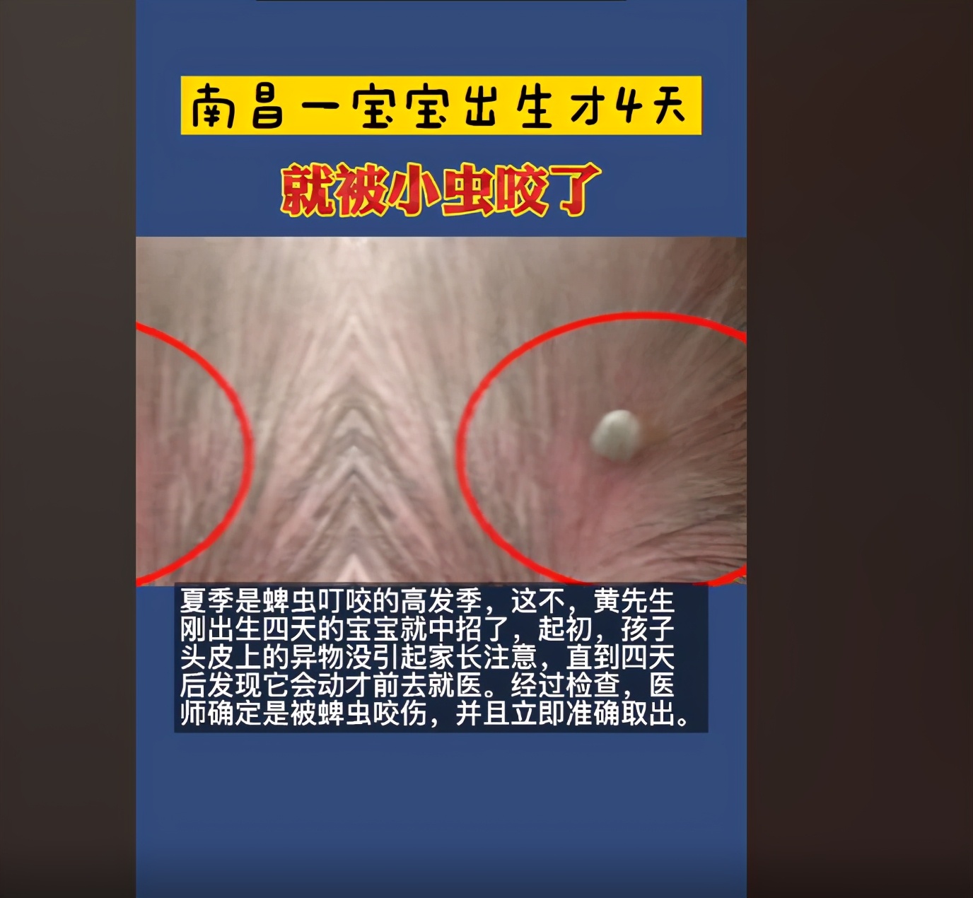 菁妈育儿|出生4天的婴儿被虫咬伤送医，夏天来了，让娃远离这种“毒虫”