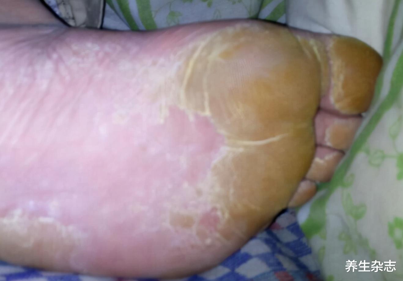 肝脏|转告家人：脚上若有4个异常，肝可能已经受损，劝你早查肝功能