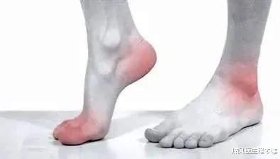 痛风医生程本维|痛风的5个阶段，千万别错过治疗的黄金时期