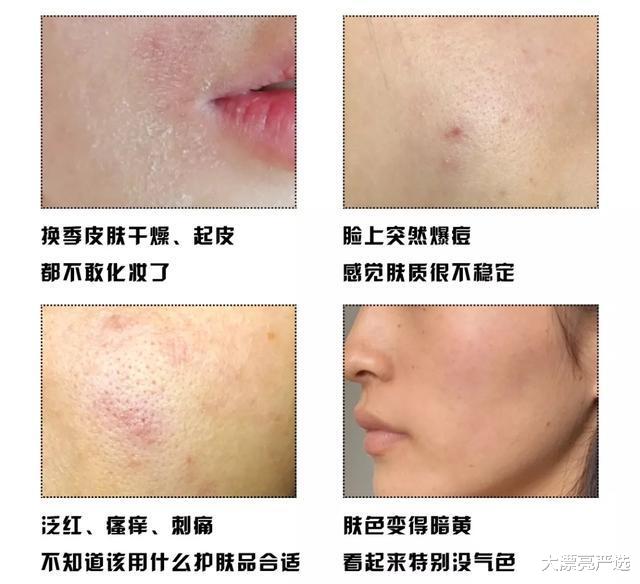 林允 23岁林允自曝“毁容”经历：皮肤屏障受损，有这个习惯一定要改