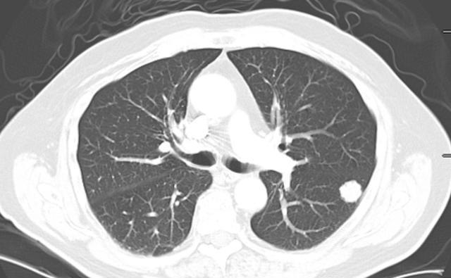 医生|肺部健康很重要，教你2招保护肺部的小妙招，可以借鉴一下