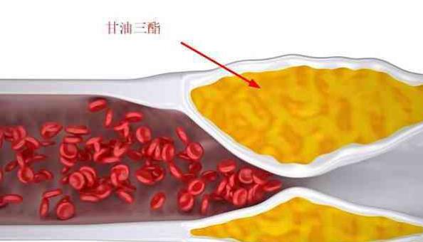 甘油|甘油三脂由6.3降到1.6，煤老板分享经验：多吃一物，血管慢慢通透