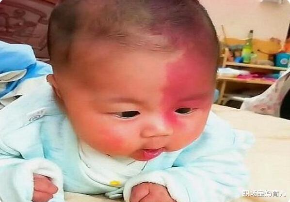 职场宝妈育儿|产科医生：想要孩子出生没胎记，孕期坚持“3不要”，以免娃自卑