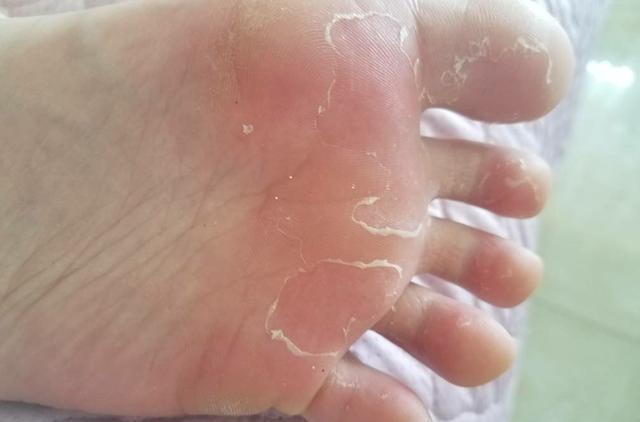 肝脏|肝不好，脚先知？如果双脚发出4个信号，建议及时做个肝功检查