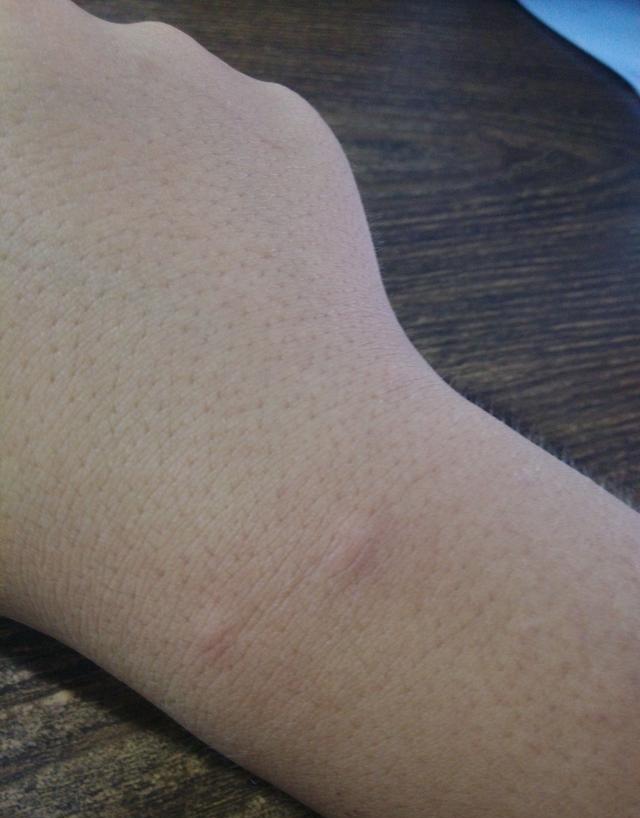 荨麻疹|夏天是荨麻疹高峰期