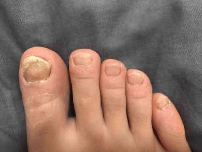 资讯健康见见康康|灰指甲的临床表现有哪些?日常需要怎样护理?
