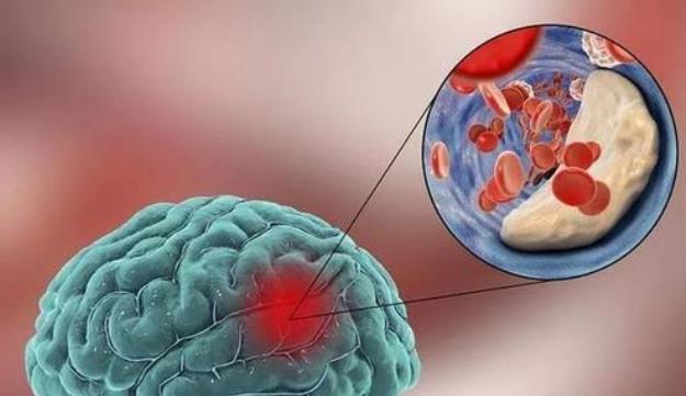 医生|53岁女子发生脑溢血，医生建议：这种食物或许要忌口，你有吃过吗