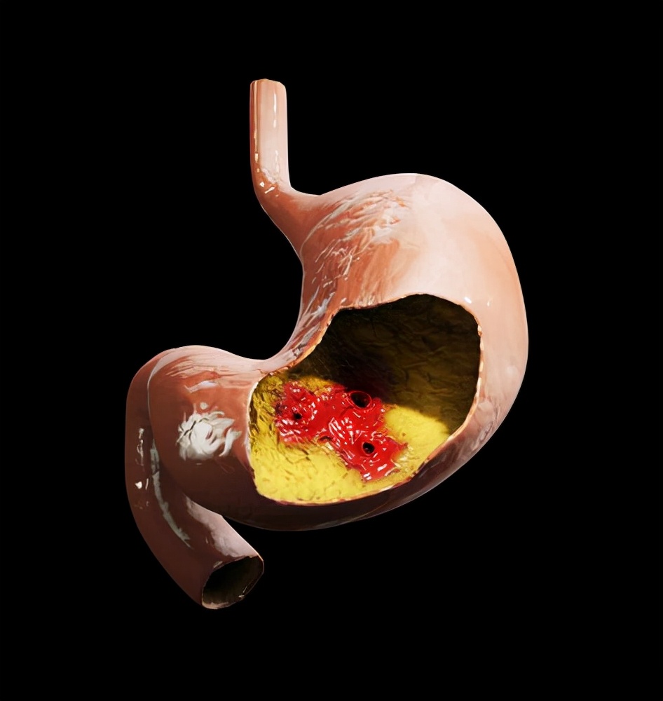 胃病|胃药餐前吃还是餐后吃？若想保证用药的效果，不妨了解下