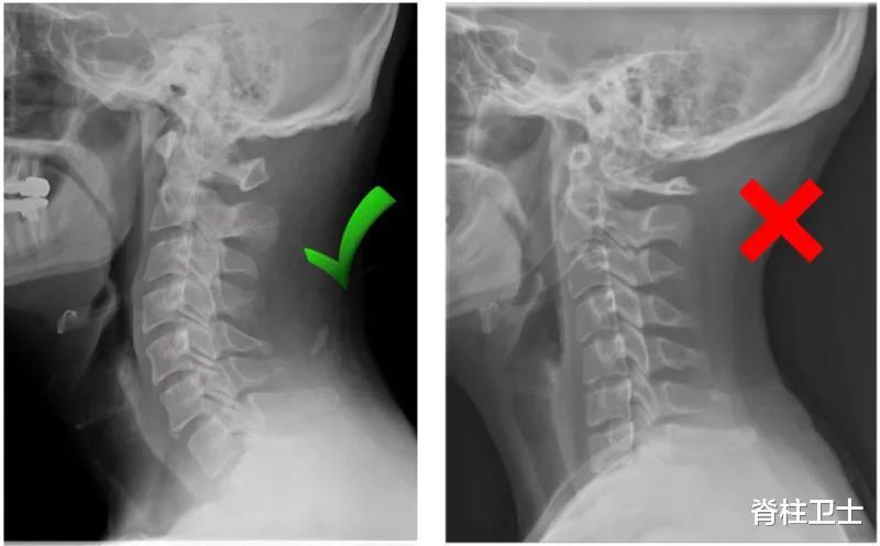 颈椎病|颈椎变直后如何矫正？这里有答案！