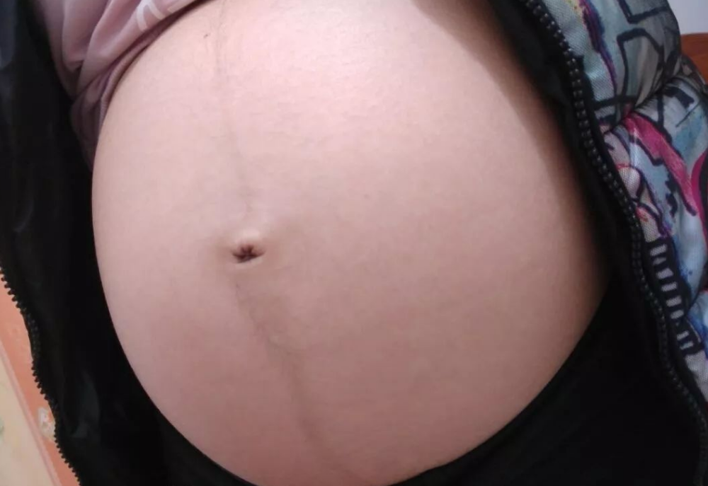 父母育儿观|孕妇肚皮上的那条“黑线”,除了和胎儿有关,还与这些原因相关