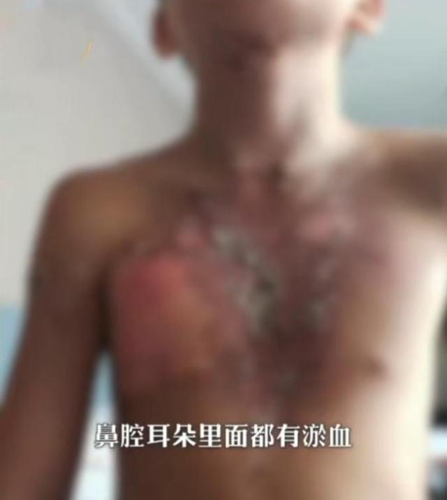 江湖奇闻 河北一体校5名10岁学生遭同学用火烧、开水浇，校园霸凌何时休？