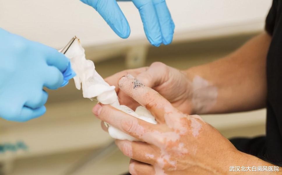 白癜风|男性白癜风快速扩散是什么原因?该怎么办?