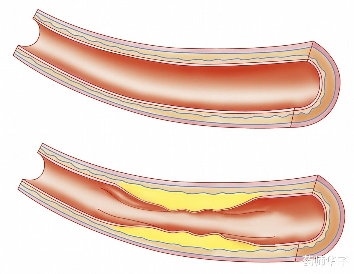 胆固醇|吃他汀类药物预防脑梗塞，把低密度脂蛋白胆固醇，降到什么水平？
