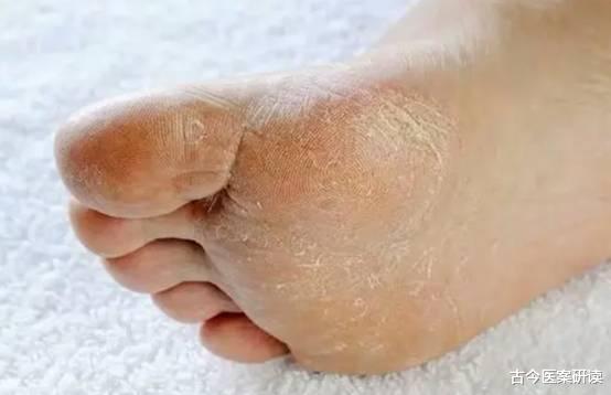 古今医案研读|长年累月受脚气折磨，如何根除？白糖真的可以治疗脚气吗？
