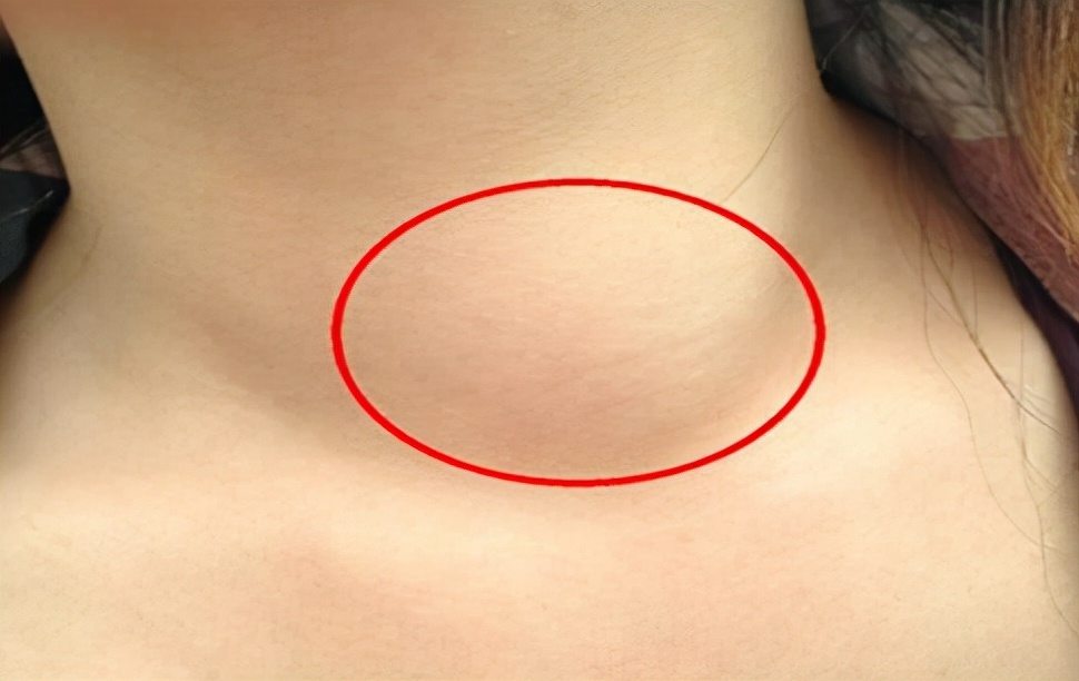 医生|夫妻双双患甲状腺癌,医生:炒菜常放“它”,钢铸的甲状腺也难抗