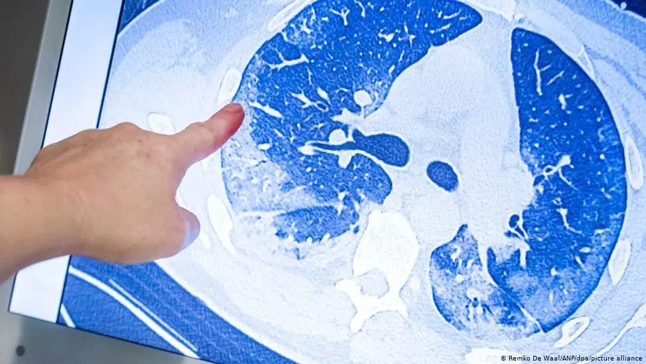 红团团医生LYNN|26%新冠患者有精神症状？出院12月仍有问题，新冠后遗症数据公布