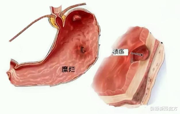 健康新经官方 50岁大姐肠胃不好，吃南瓜养胃，医生：“1物”养胃灭菌，比南瓜好10倍
