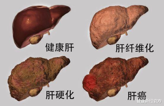 健康新经官方 35岁男子呕血不止，3次化疗，肝癌离世，医生咆哮：跟母亲脱不了关系