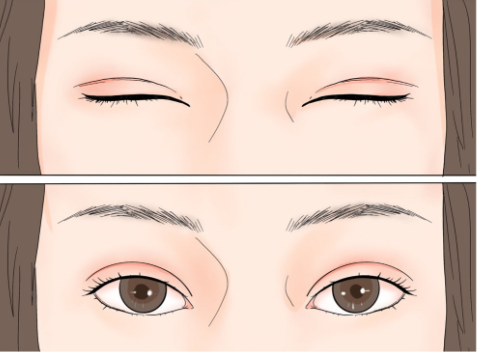 史迎军眼整形|史迎军眼整形 | 双眼皮术后5问，想做双眼皮还不快来了解一下