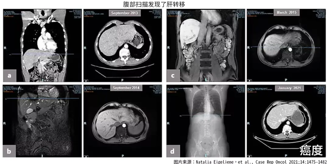 便秘|多模式组合治疗，晚期转移性肠癌患者，生存已超过9年