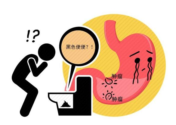 胃癌|提醒胃病患者:一旦出现3种迹象,胃癌可能即将到来,别忽视