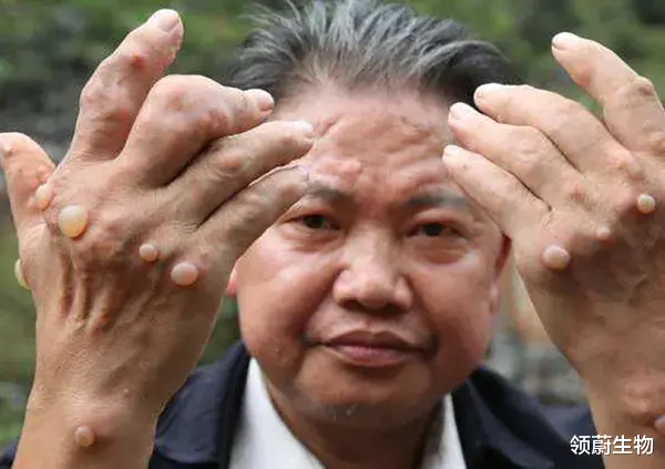 领蔚生物|痛风思“痛”│痛风患者的健康管理