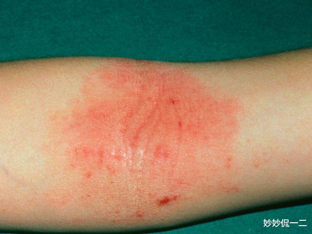 |艾滋病隐藏时间长,如果身体出现三个信号,就需要赶快就医了