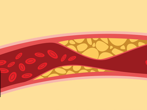 芹菜|血管“刮油机”已公布，芹菜榜上无名，此物若爱吃，血管干干净净