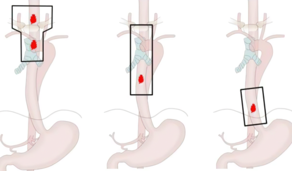 食管癌|“老戏骨”患癌，从发现到去世仅1个月，医生：3个省份是高发地区