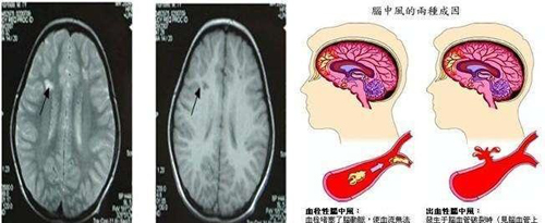 择思达斯 脑血栓患者怎么做康复