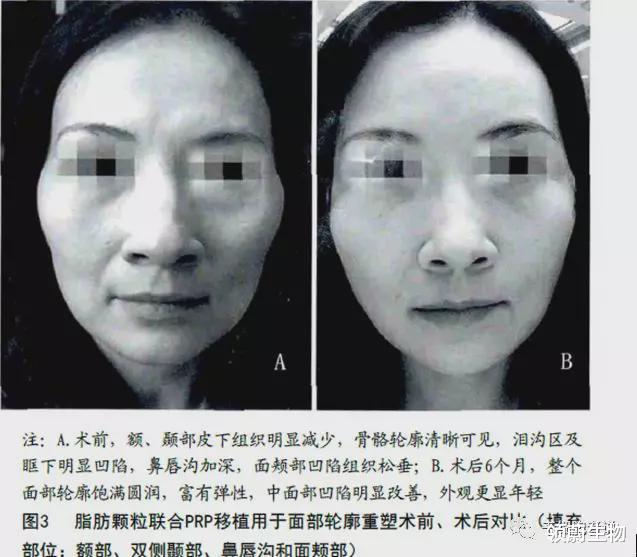 领蔚生物|刘若英治疗膝盖用的是干细胞吗？