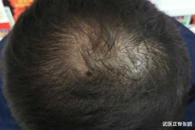 肝硬化|45岁叔叔坚持养生,确诊肝硬化,医生:3种中药堪称“烂肝王”,勿食用