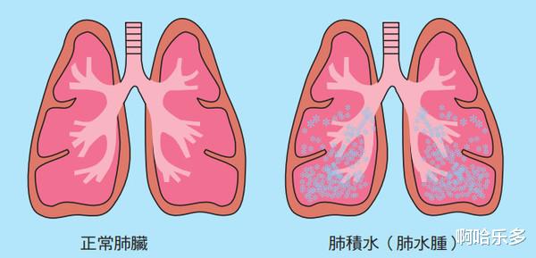 啊哈乐多|唐跃良  胸腔积液的治疗方式？