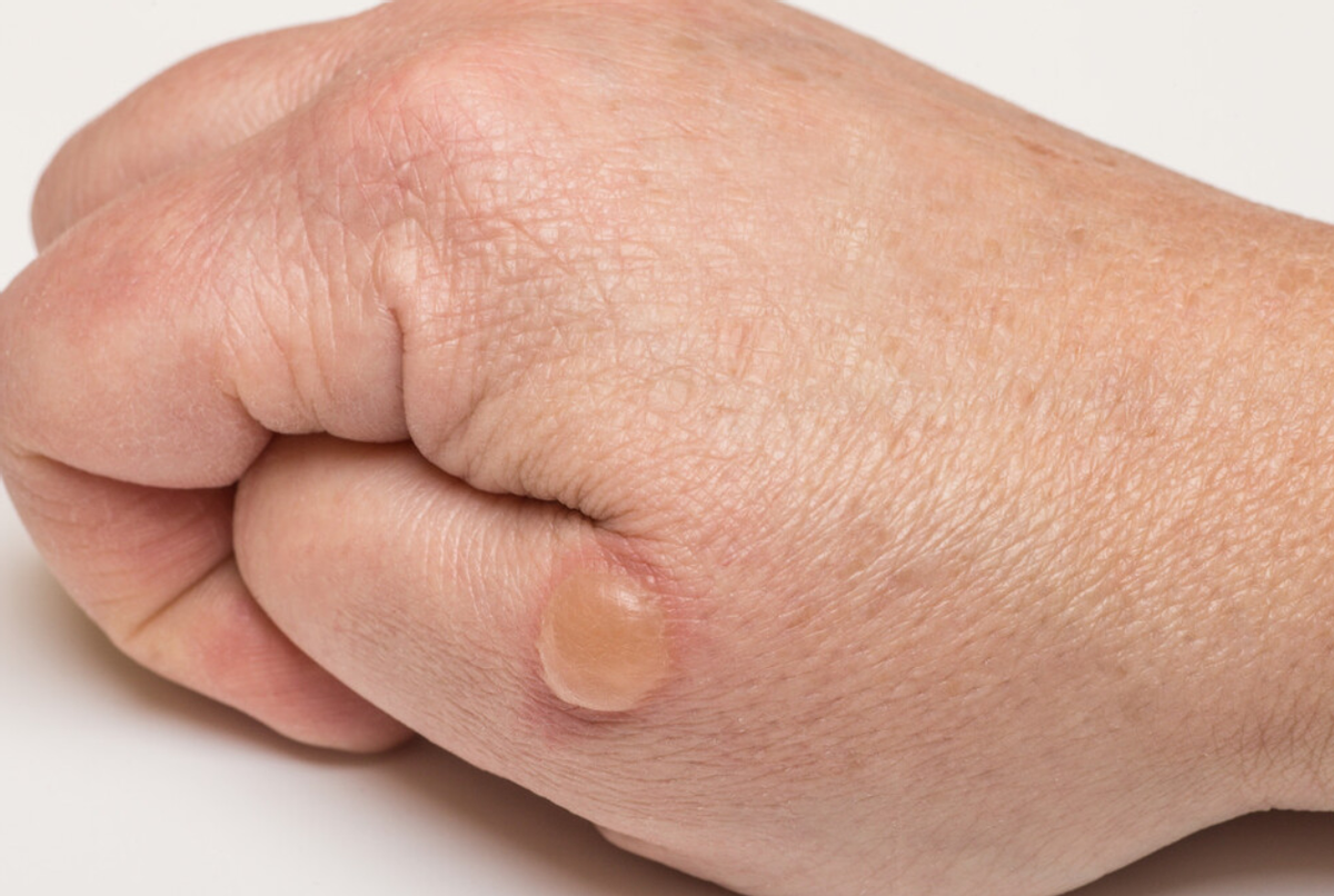 流鼻血|皮肤上有这3种变化，恭喜你被HPV“看上了”，做到这2事就能避免