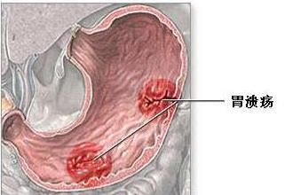 牛奶|胃溃疡患者大量喝牛奶有助胃溃疡修复?你的错误认知还要坚持多久