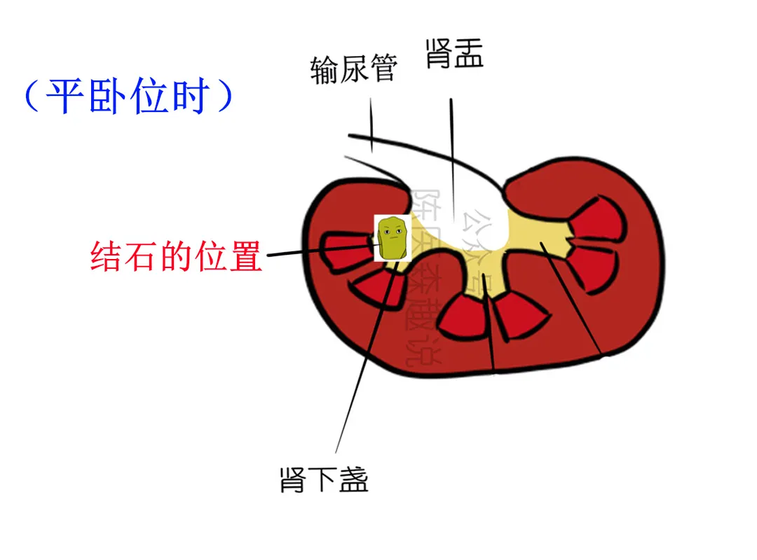 陈医森趣说|肾下盏的结石很难排出？一定要试试这个方法