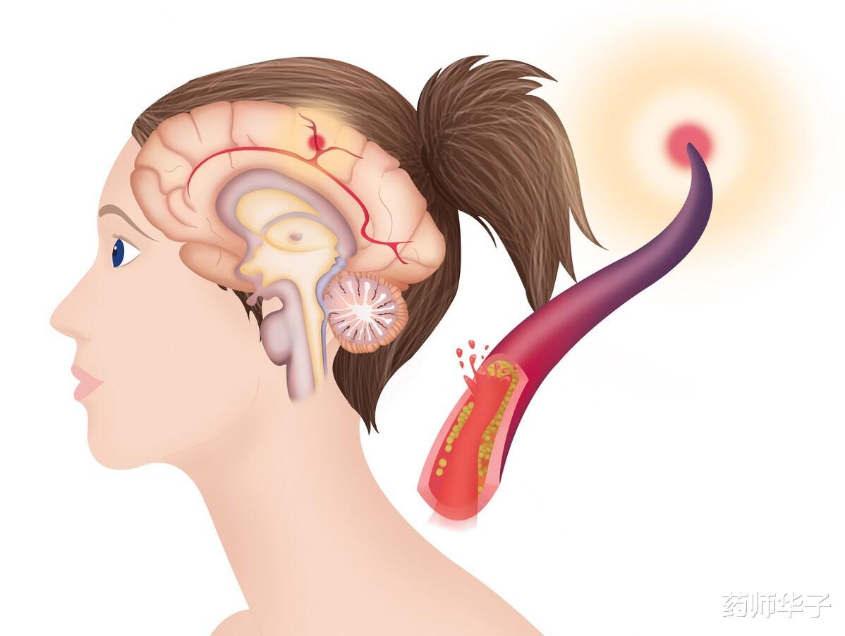药师华子|腔隙性脑梗塞要不要吃药？需要看病因，避免过度治疗