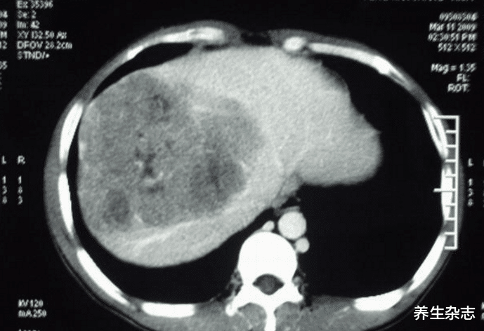 肝癌|47岁女教师确诊肝癌，医生叹息：糊涂！鸡蛋和它一起煮，等同于“吃毒”