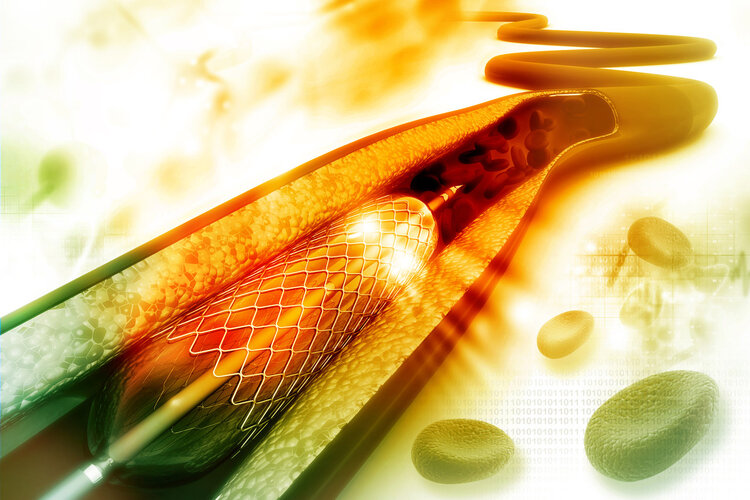 心脏|心脏支架后活不长?和你实话实说:想要寿命不受影响,做好3点