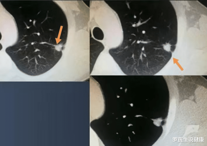 罗医生说健康 辟谣：CT报告中的“肺结节”、“占位”都是肺癌？