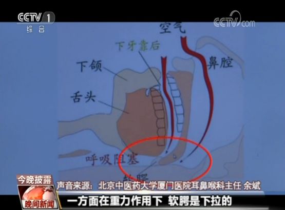 佳康时代|打鼾隐患大,严重者会猝死,央视多次报道提醒早治疗!