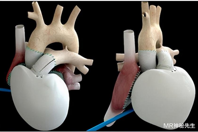 人工心脏|一个没有心脏的男人,坚强的活着努力锻炼,你还有什么理由叫苦?