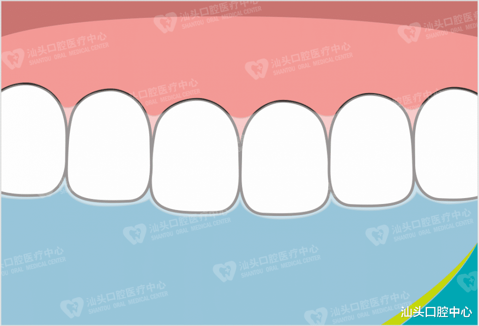 汕头口腔中心|隐形牙套和钢牙套哪个好？区别在哪？要戴多长时间