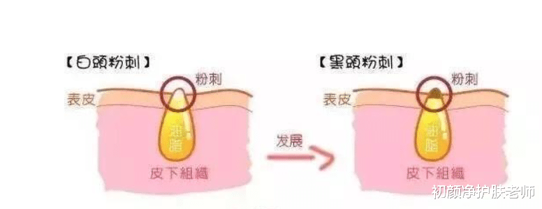 黄芪 建议有“闭口”的女生，坚持做好这几件事，高效解决不反复！