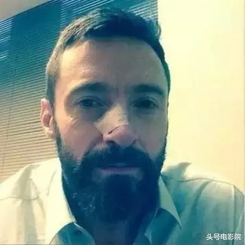 金刚狼|再爆皮肤癌危机！53岁金刚狼接受活检，与大13岁老婆结婚25年无孩