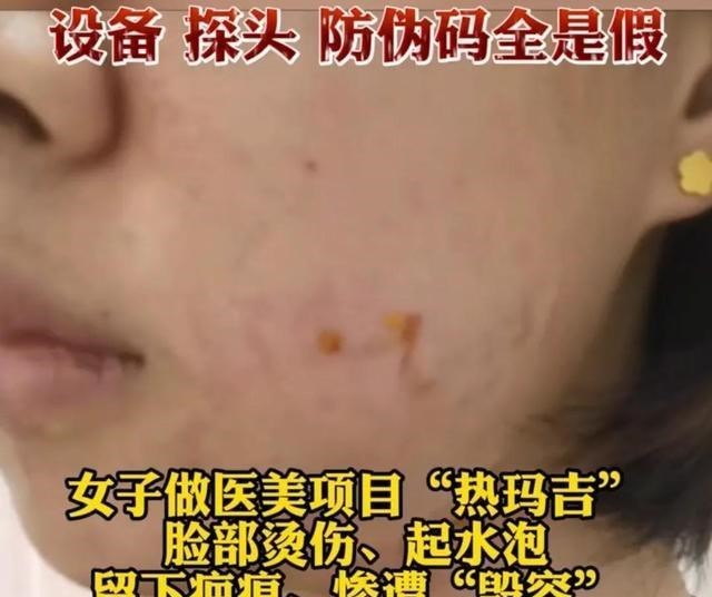 上海:女子花两万元做医美,惨遭毁容烂脸,所谓进口设备全是假货